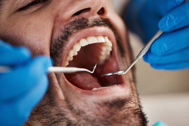 Best Emergency Wisdom Teeth Removal in Chatmoss, VA